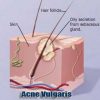 acne vulgaris or pimple