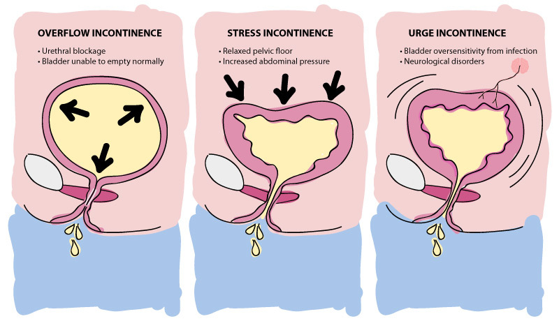 What Is The Most Common Cause For Urge Incontinence Pharma Mirror 