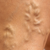 Leg Veins: Why They Appear and How Vein Doctors Treat Them